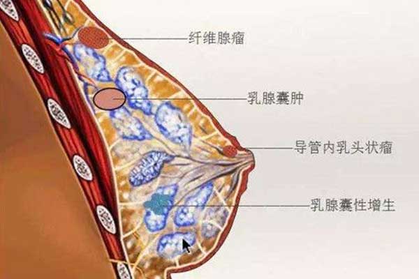 乳腺癌四种症状