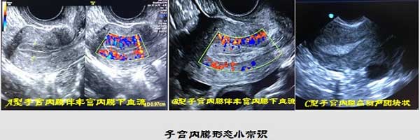 不同形态子宫内膜实图