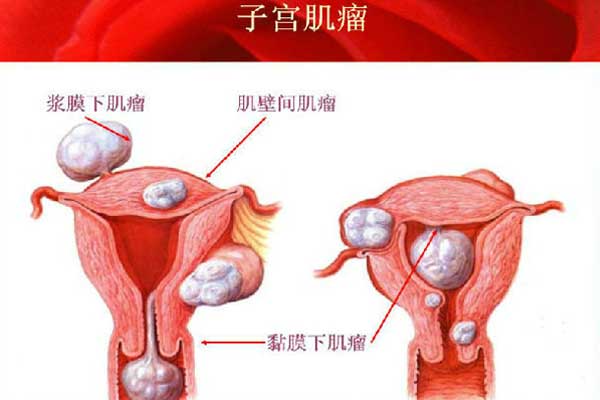 子宫肌瘤对怀孕的影响不可忽视