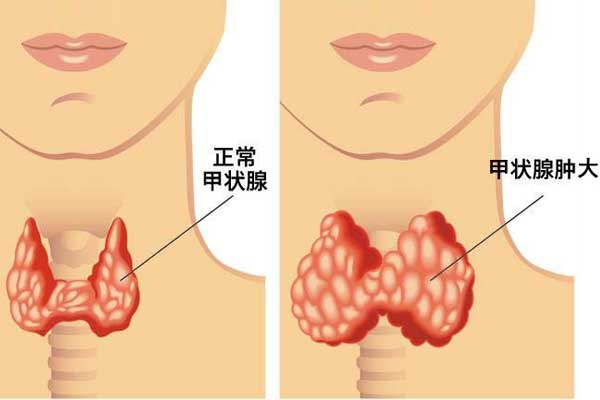 甲状腺检查