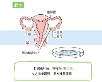 取卵取精过程